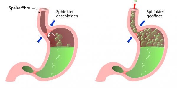 Gasförmiger Reflux und unterer ösophagus Sphinkter