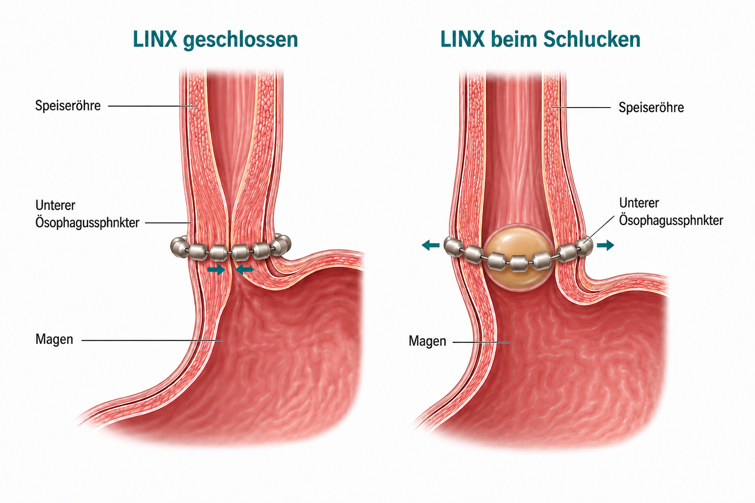 LINX geschlossen und beim Schlucken