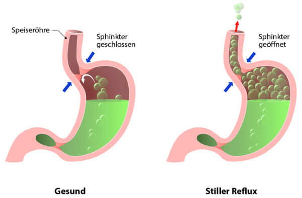 Visualisierung der Funktionsweise des Magens mit und ohne Stillen Reflux