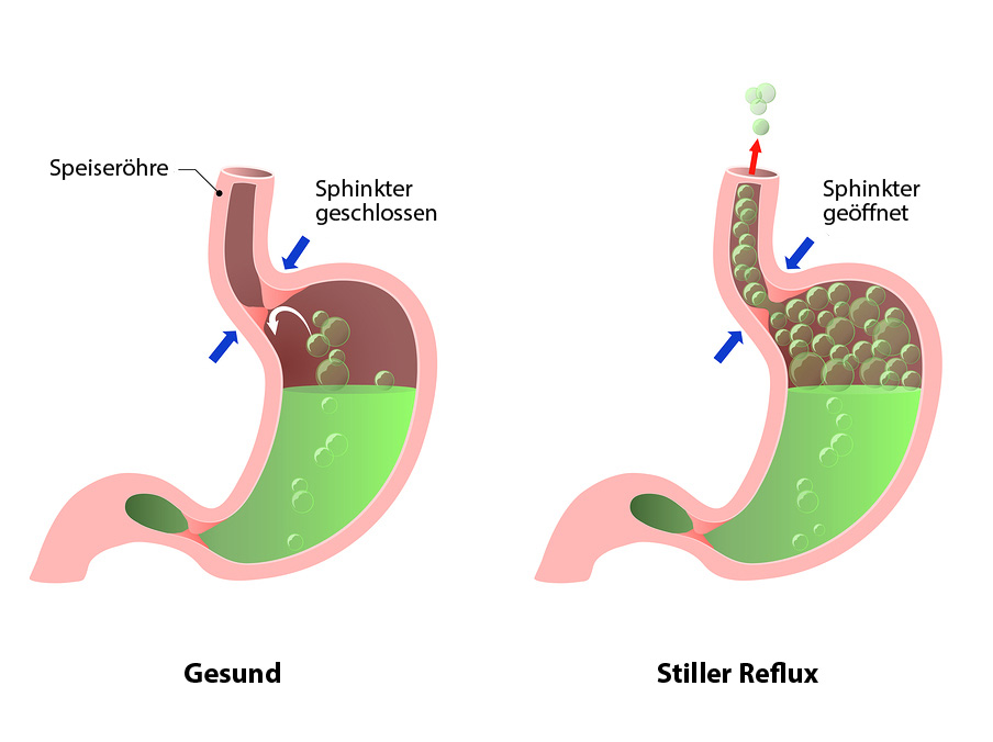 Gasförmiger Reflux und unterer ösophagus Sphinkter