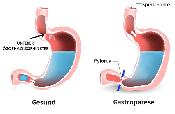 gastroparese vs gesund