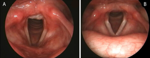 endoskopisch Aufgenommene Bilder zweier Kehlköpfe. Ein Kehlkopf hat deutliche Spuren von Stillem Reflux, der andere nicht.
