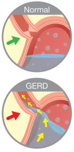 Ursache für Reflux